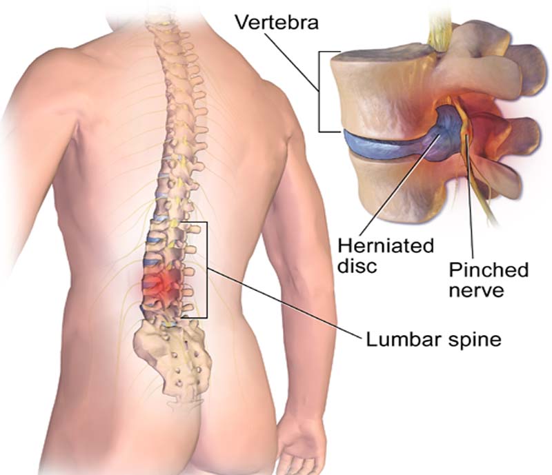 Slip Disc and Sciatica Treatment by Dr Tarun Kumar Adukia at Neuro Clinic Ranchi