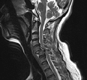Spinal Cord Injury Treatment in Ranchi